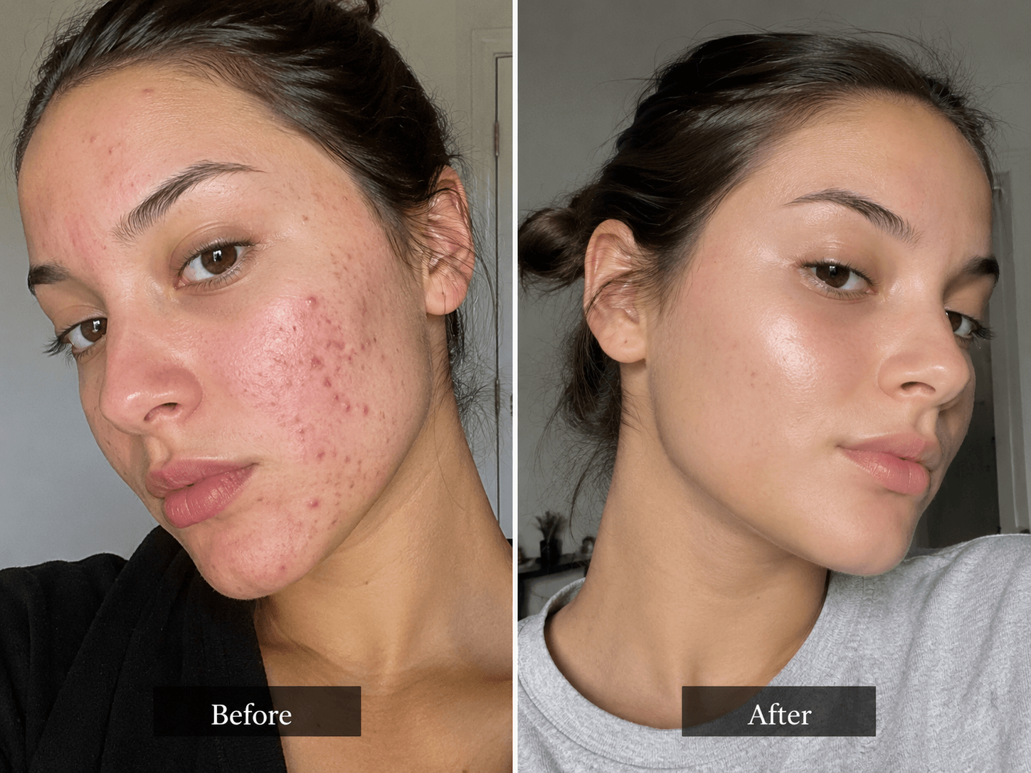 Before and after using 3 in 1 makeup removing foaming cleanser, showing skin improvement and clarity.