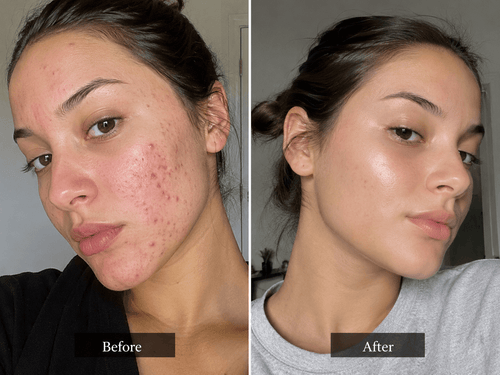 Before and after using 3 in 1 makeup removing foaming cleanser, showing skin improvement and clarity.
